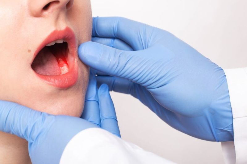 Oral Cancer Treatment